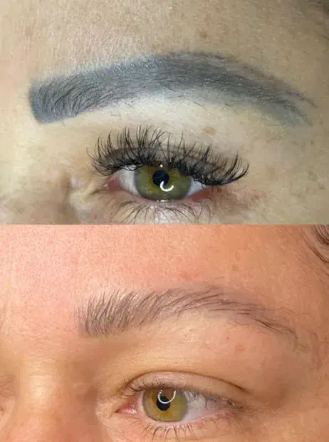 Sobrancelha com micropigmentação acinzentada antes e depois da despigmentação a laser