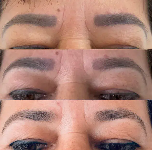 Micropigmentação de sobrancelha voltando ao natural após despigmentação a laser
