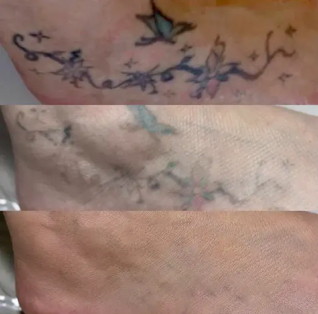 Tatuagem colorida no pé em três estágios de remoção a laser, do desenho fechado à pele quase limpa