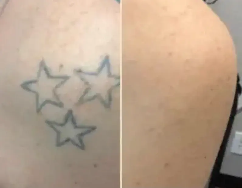 Tatuagem de três estrelas comparada lado a lado com a pele depois da remoção a laser