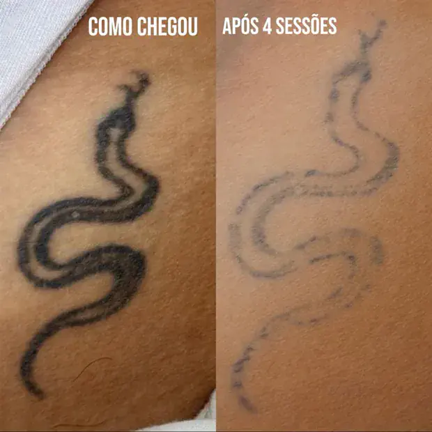 Tatuagem comparada lado a lado: como chegou e após 4 sessões de remoção a laser