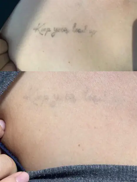 Tatuagem clareando ao longo das sessões de remoção a laser